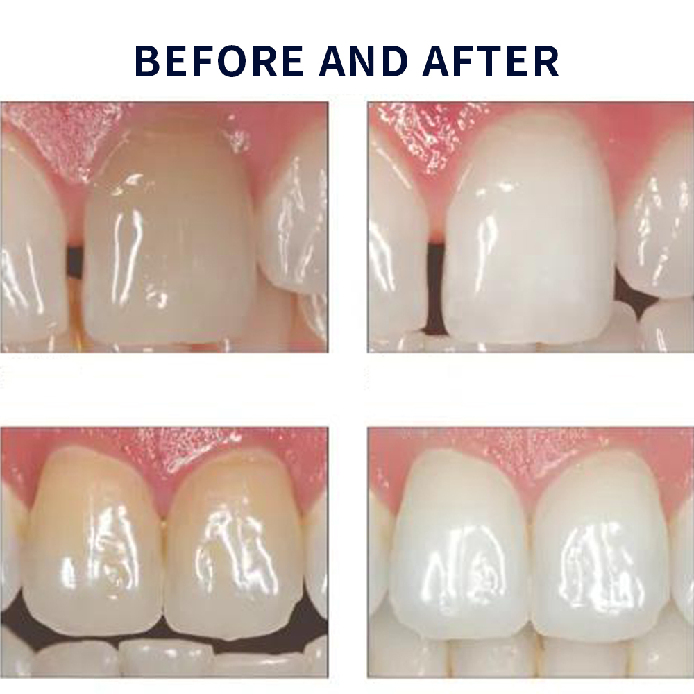 Opalescence Whitening 20% PF 2 - Teeth Whitening Gel Peroxide recension och pris