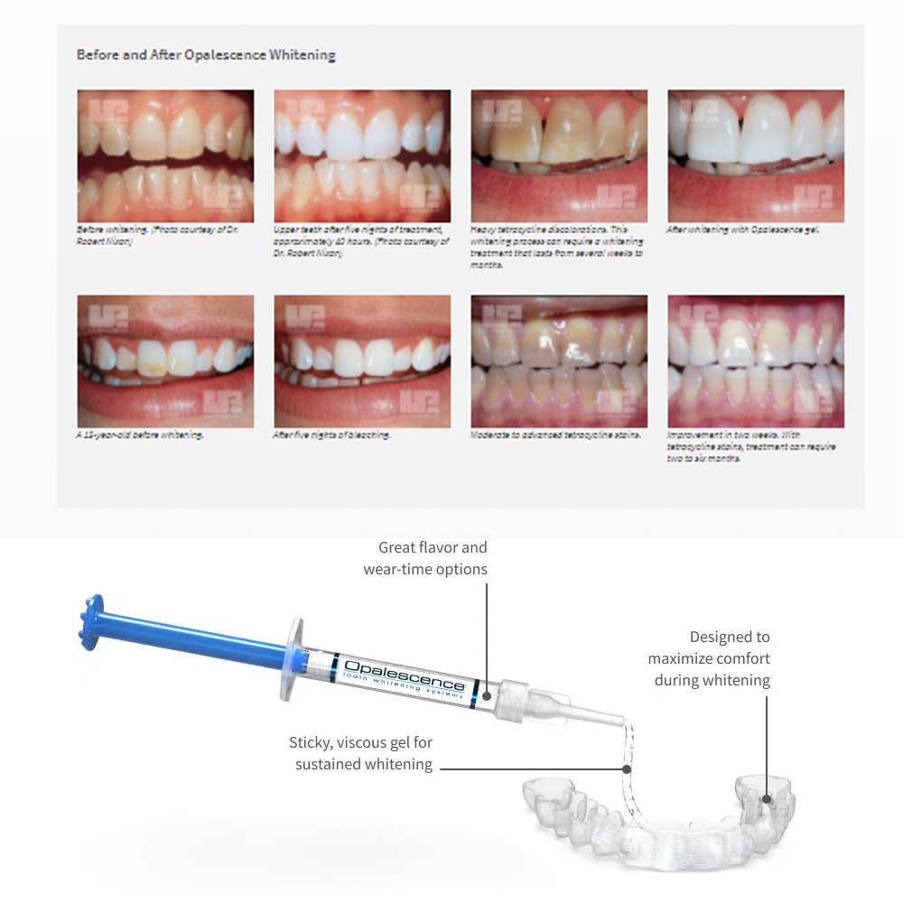 Opalescence Whitening 20% PF 2 - Teeth Whitening Gel Peroxide recension och pris