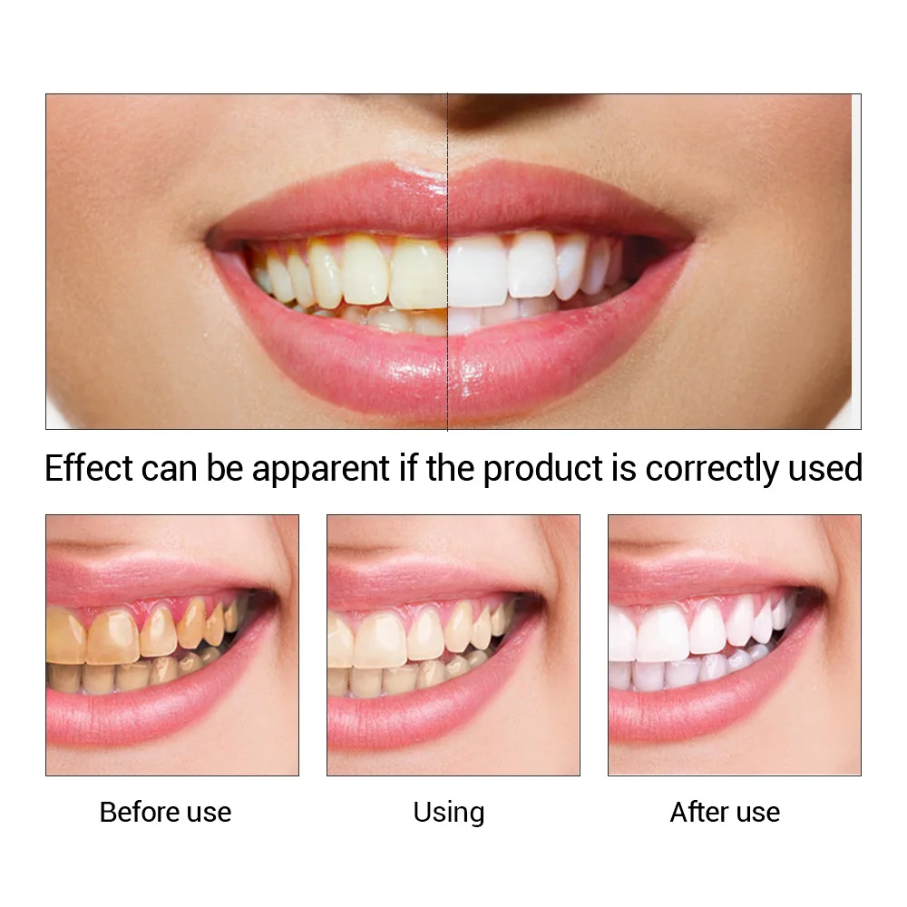 FTEENPLY Teeth Whitening Essen - Teeth Whitening Near Me recension och pris