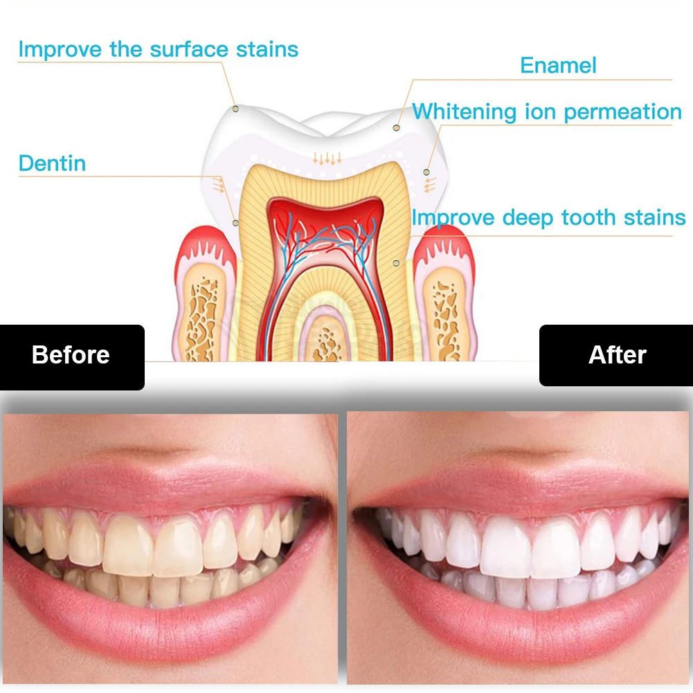 Dental Teeth Whitening Kit Min - Teeth Whitening Gel Peroxide recension och pris