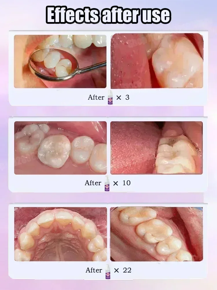 Teeth Cleaning Toothpaste Remo - Teeth Whitening Treatment recension och pris